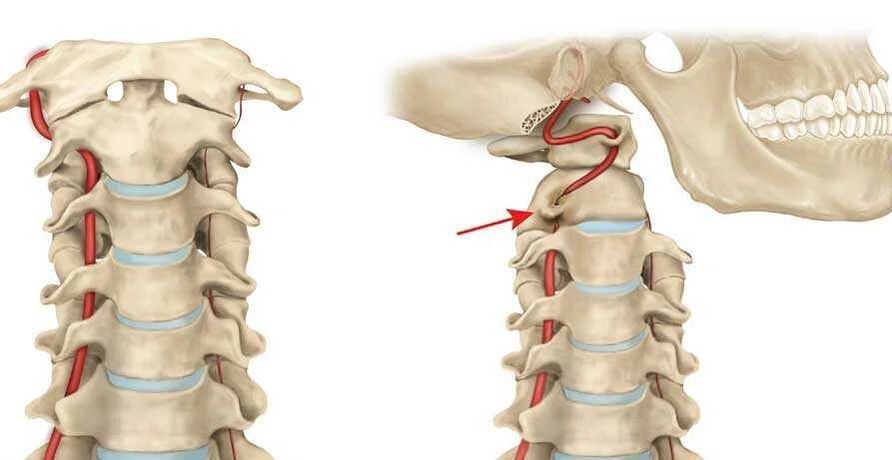 vertebral Arterie Syndrom