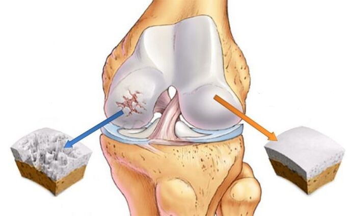 Wat ass Arthrosis
