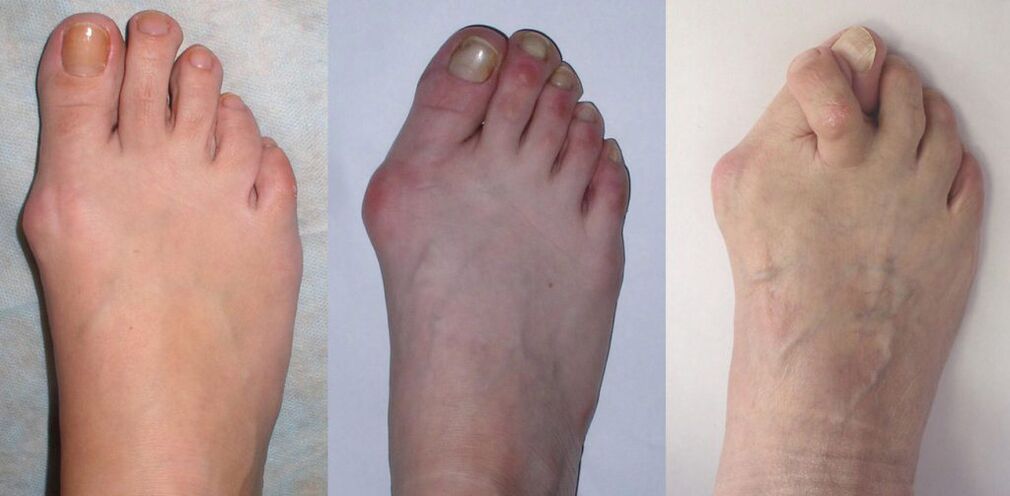 Arthritis vum Fouss
