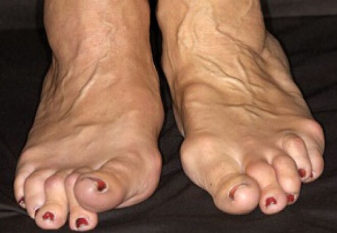 Arthrose Deformatioun