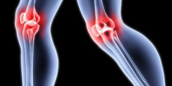 Arthrosis vum Knéi