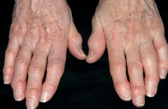 Arthrosis vun den Hänn
