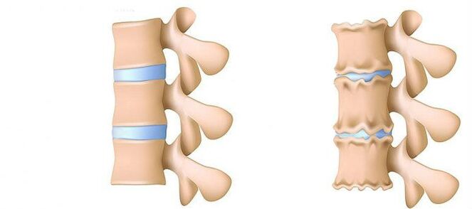 Wat ass Osteochondrosos