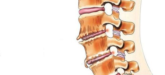 Wat ass Spondyloseën