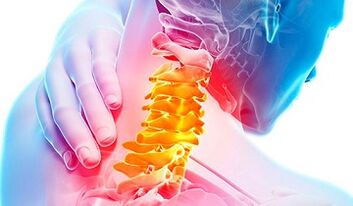 Unzeeche vun Osteochondrosis vun der Gebärmutteralesch Wirbelsäule