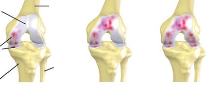 Grad vun Arthrosis
