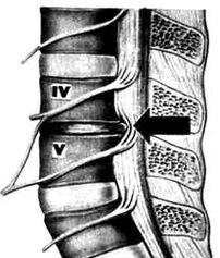 X -ray Bild vum Lumbar Departement vun Osteochendrosis
