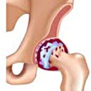 Arthrosis vun der Hip Gelenk