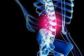 Osteochondrose vun der Lendegéigend