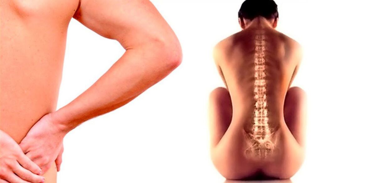 Schmerz am ënneschte Réck wéinst Osteochondrose