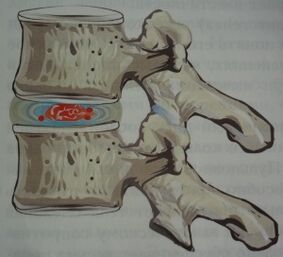 Éischt Stuf vun Osteochondrose