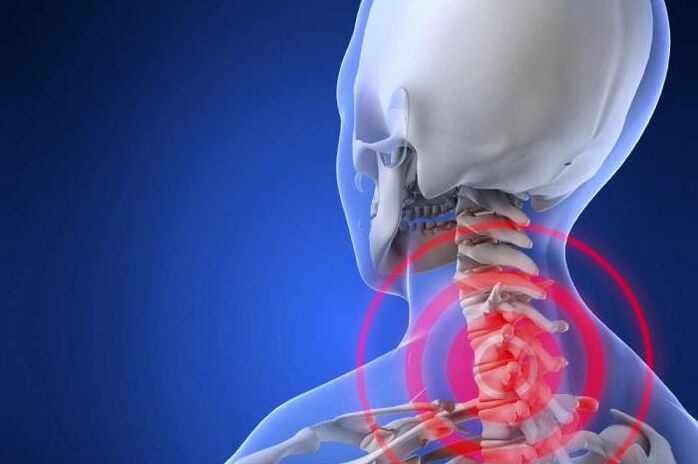 Schéissen Schmerz am Hals ass e fréie Symptom vun der Gebärmutterkierper Osteochondrose